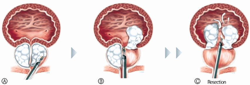 BEST PROSTATE TREATMENT IN JALANDHAR 2023.