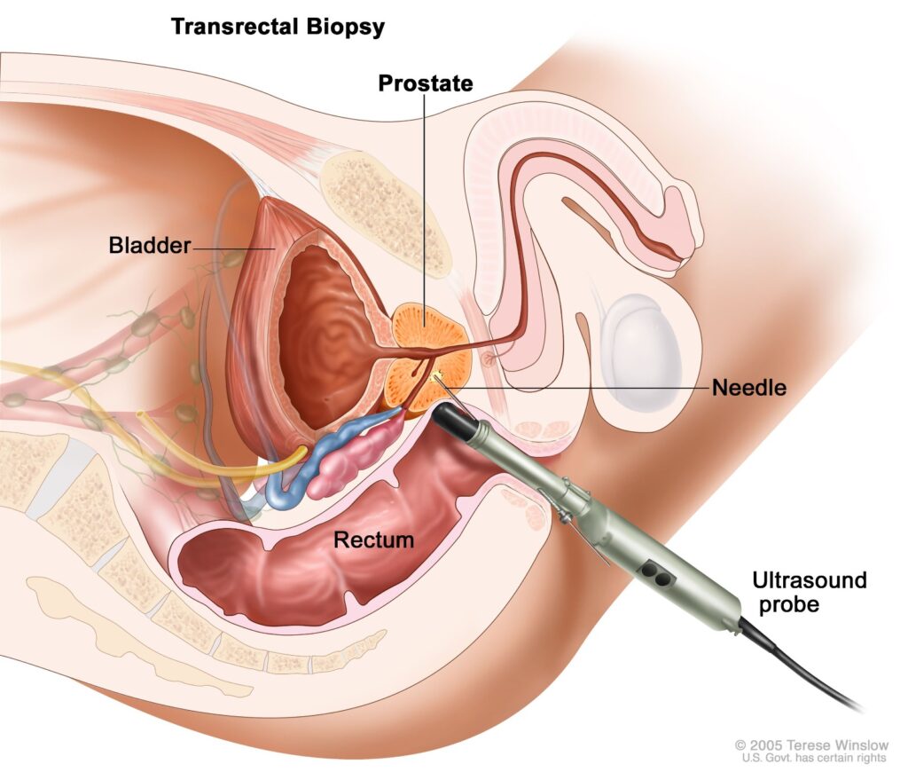 BEST TRANSRECTUAL ULTRASOUND GUIDED BIOPSY IN 2023